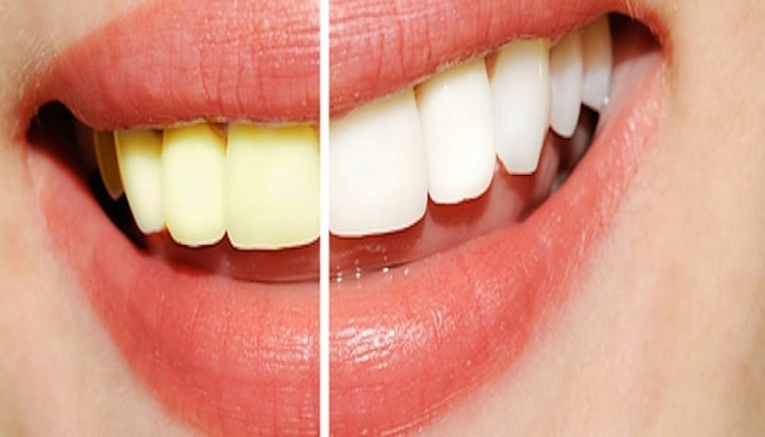 9 Amazing Ways to Whiten Your Teeth