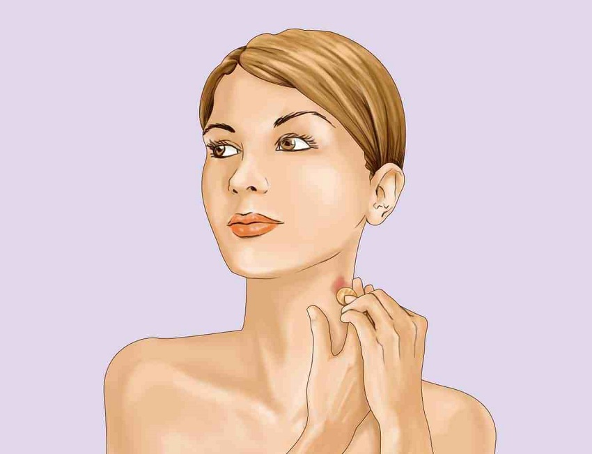 Love marks? See how to remove hickeys in less than 5 minutes
